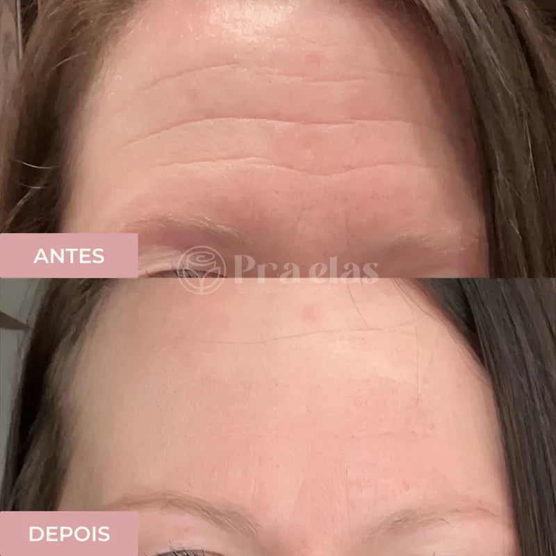 [LEVE 2 PAGUE 1] Creme Antirrugas Instantâneo Efeito Botox - (8 Horas de Duração) ®